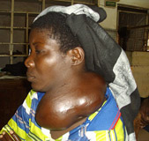 A mother with a cancerous growth on her neck